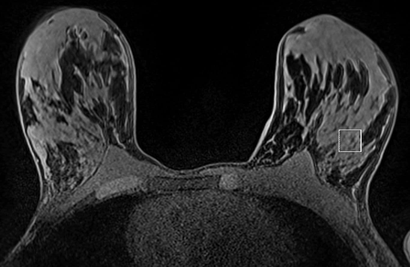 MR Spectroscopy Shows Early Warning Signs for Women with BRCA