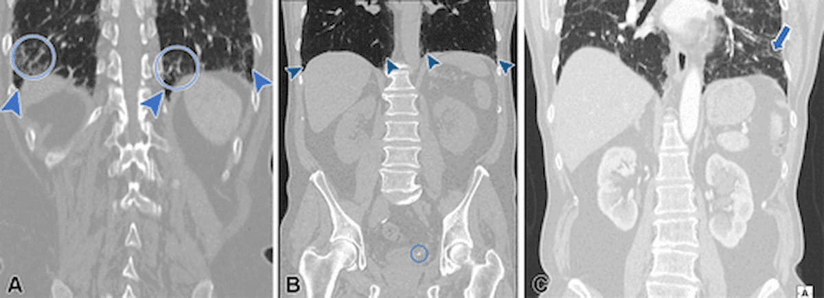 Computed Tomography Study Finds Nearly 44 Percent of Interstitial Lung Abnormalities Are Not Reported