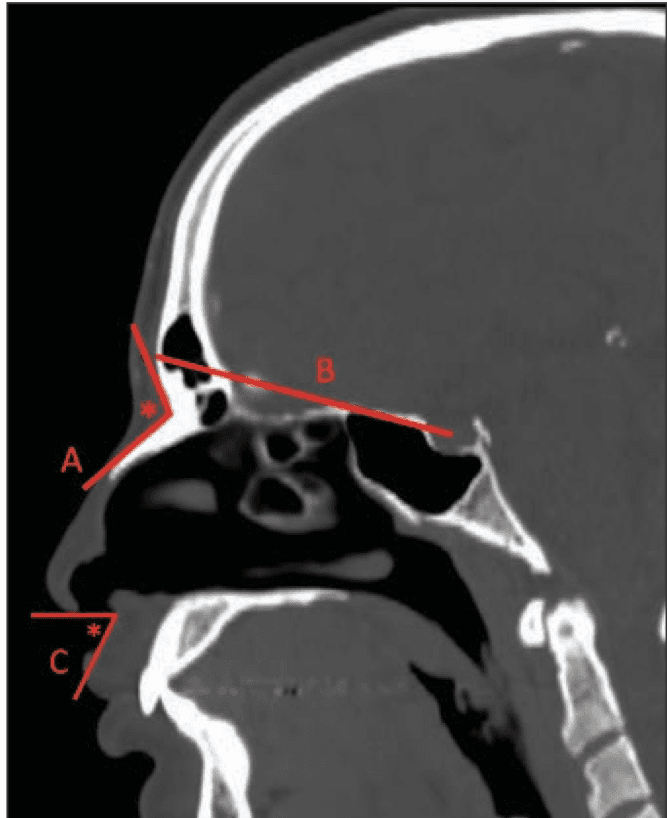 Radiologists Can Play a Role in Facial Feminization Surgery