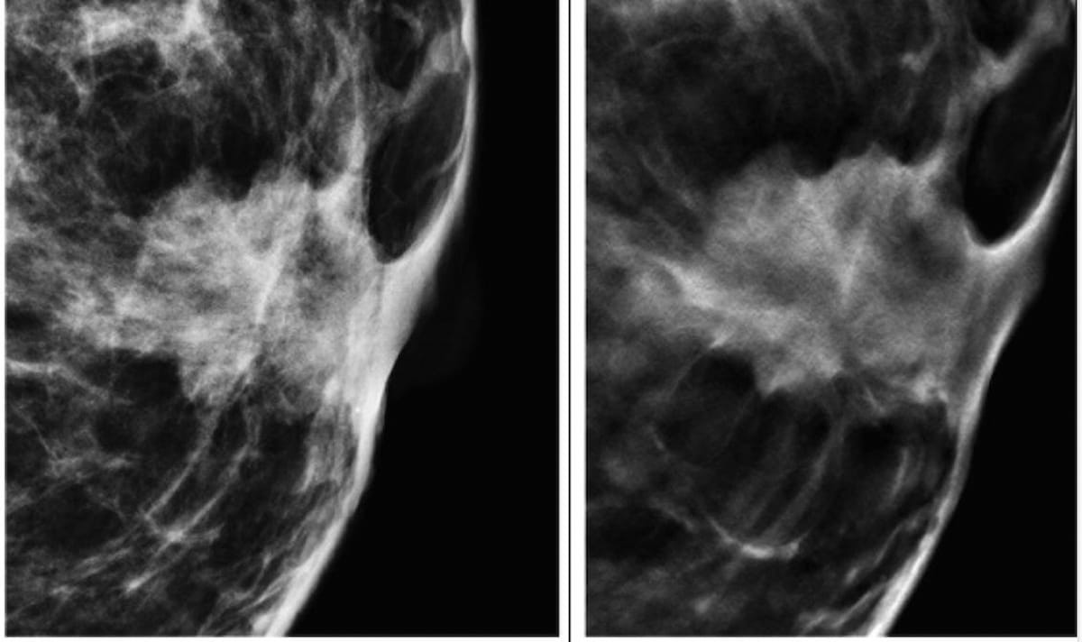Mammography Study Finds No Additional Benefit with DBT in Women with Elevated Breast Cancer Risk