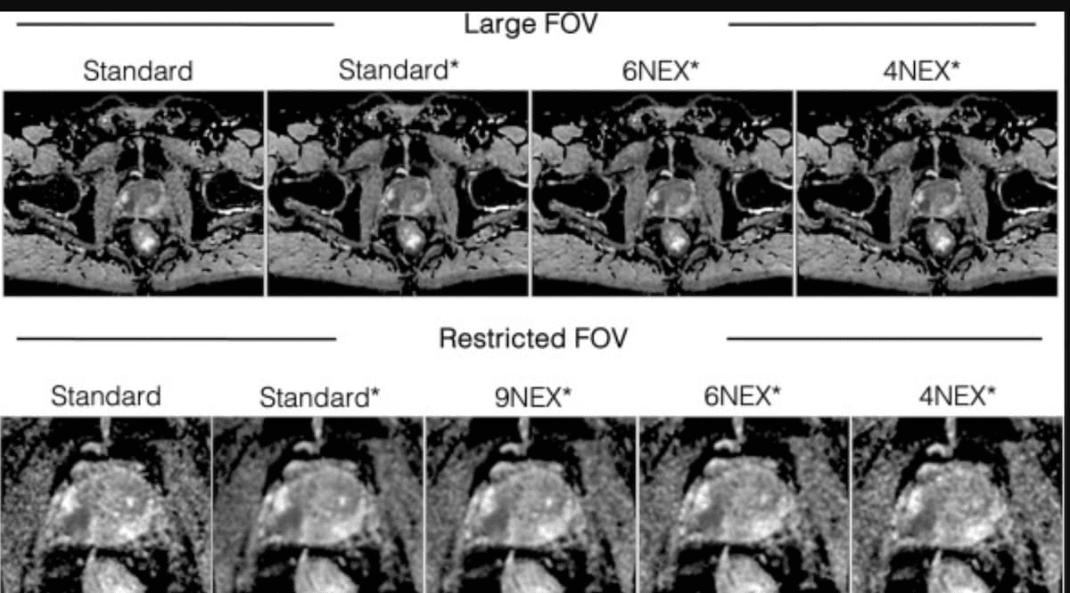 Can Deep Learning Reduce DWI MRI Exam Time Without Affecting Prostate Image Quality?