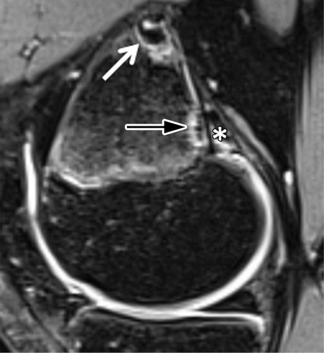 Knee irregularity