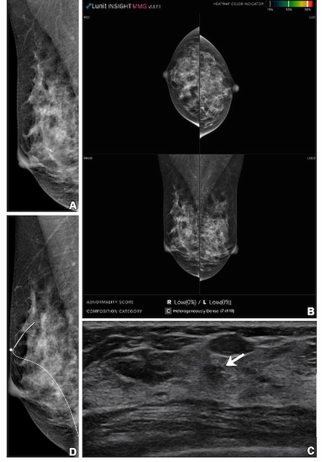 Mammography Study Shows Supplemental Ultrasound Has Higher Sensitivity than Adjunctive AI in Dense Breasts