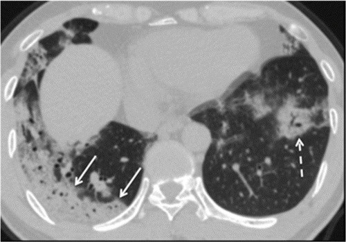 Chest CT Findings Reflect Time of Coronavirus 19 (COVID-19) Disease Course