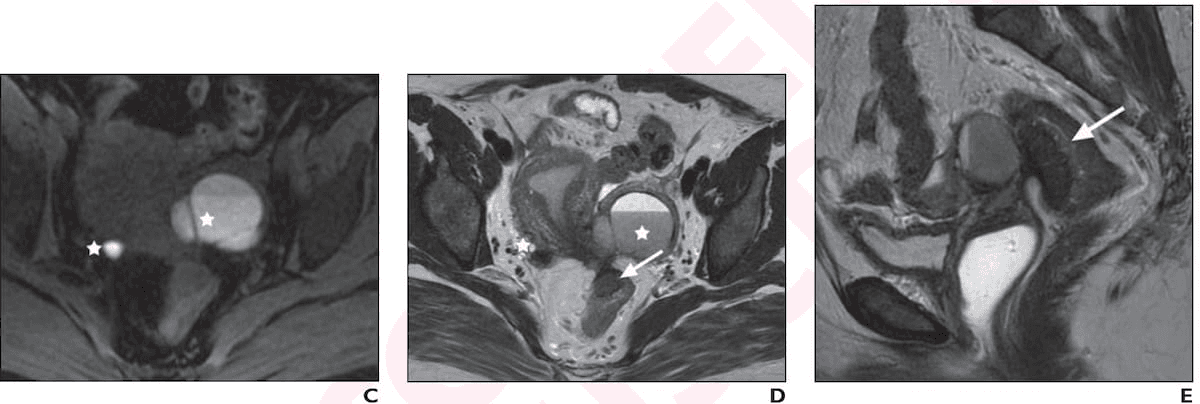 MRI or Ultrasound for Evaluating Pelvic Endometriosis?: Seven Takeaways from a New Literature Review