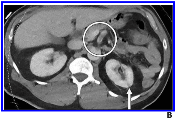 CT Reveals Higher Abdominal and Pelvic Hypercoagulability in COVID-19 Patients