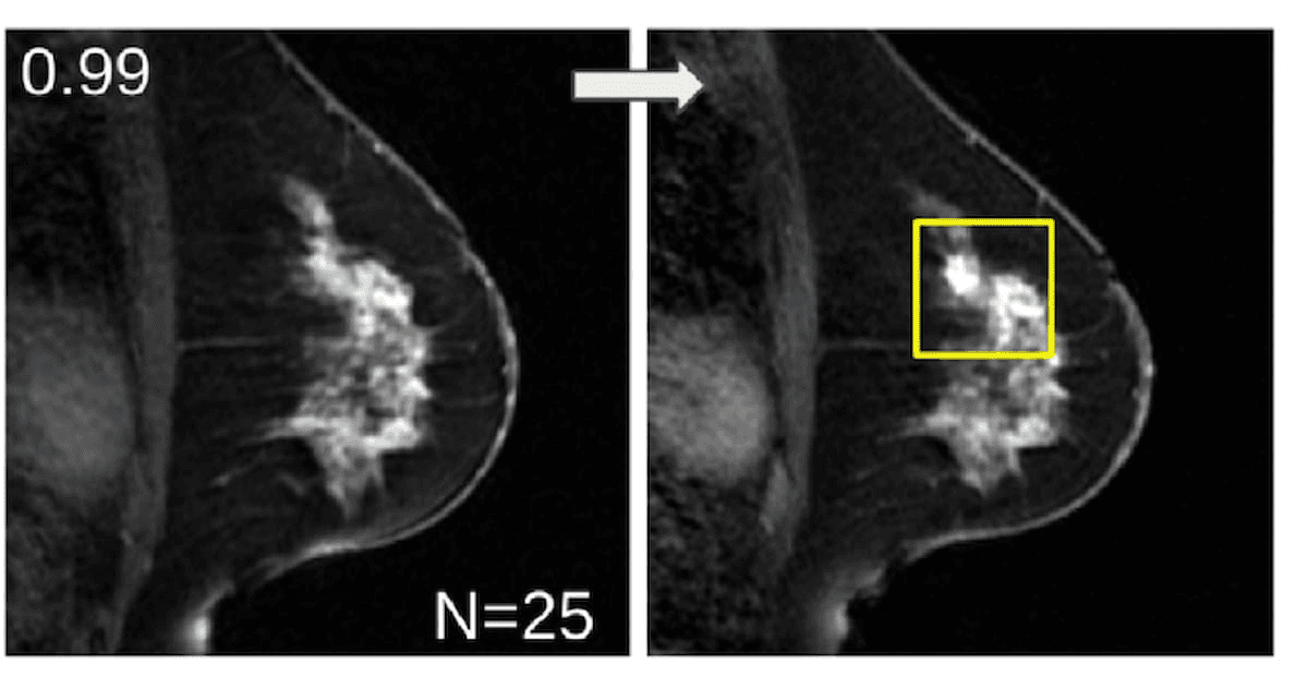 Can an Emerging AI Model Enhance Early Breast Cancer Detection on MRI?