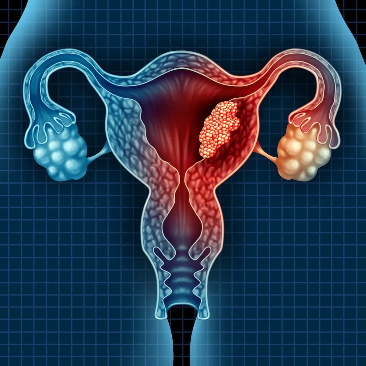 Study Finds Transvaginal Ultrasound Unreliable for Detecting Endometrial Cancer in Black Patients