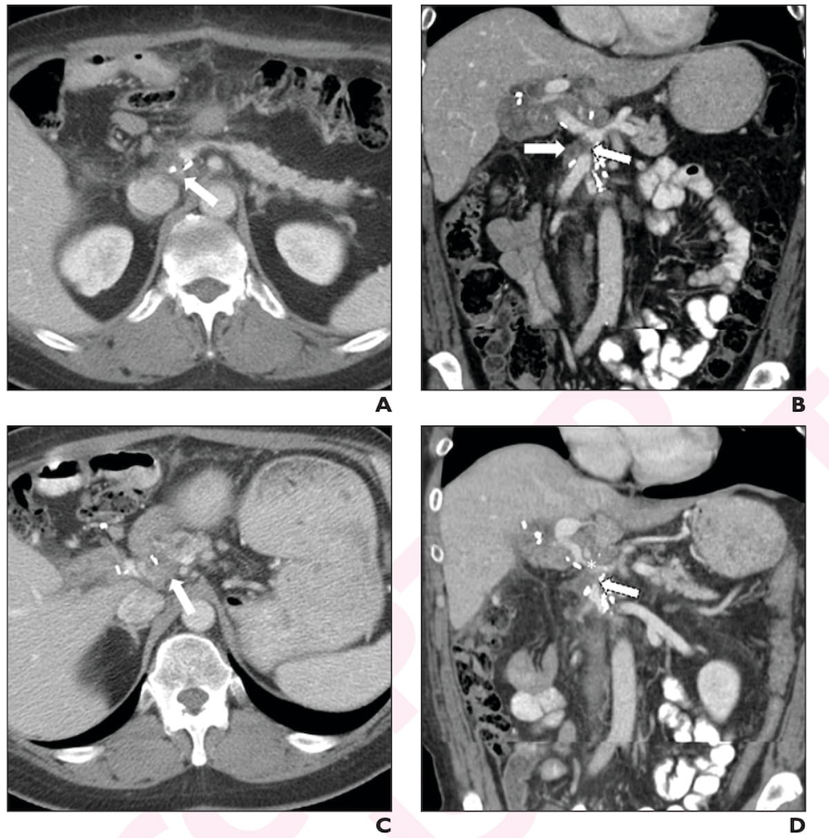 New Study Identifies Key Computed Tomography Findings for Post-Op Recurrence of Pancreatic Cancer