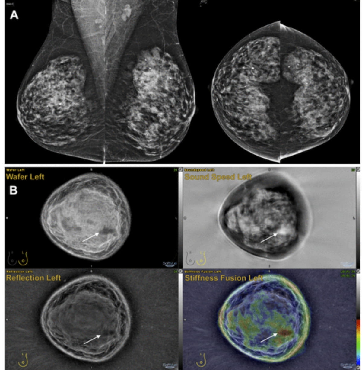 What a New Study Reveals About Whole-Breast Ultrasound Tomography, Mammography and Dense Breasts