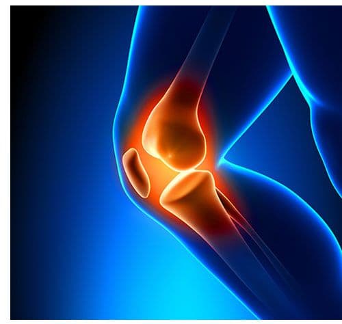 MRI Differentiates Knee Synovitis Patterns