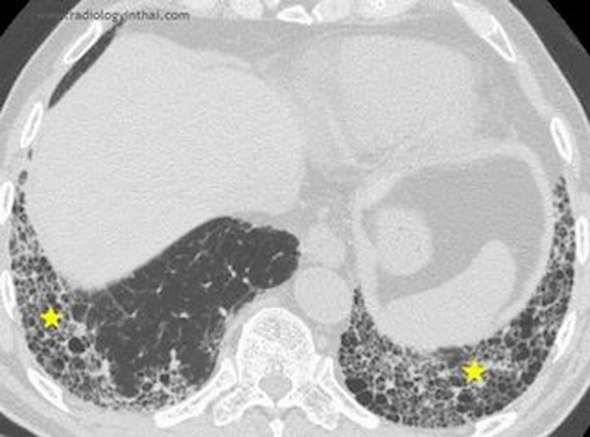 Image IQ Quiz: 60-Year-Old Man with Progressive Shortness of Breath and Cough