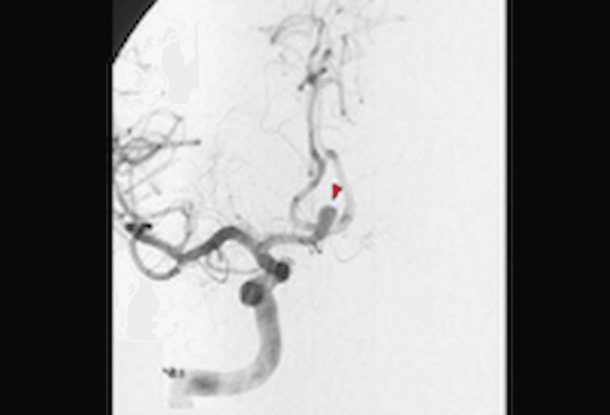 Image IQ Quiz: 35-Year-Old Patient with Painful Headache and Nausea