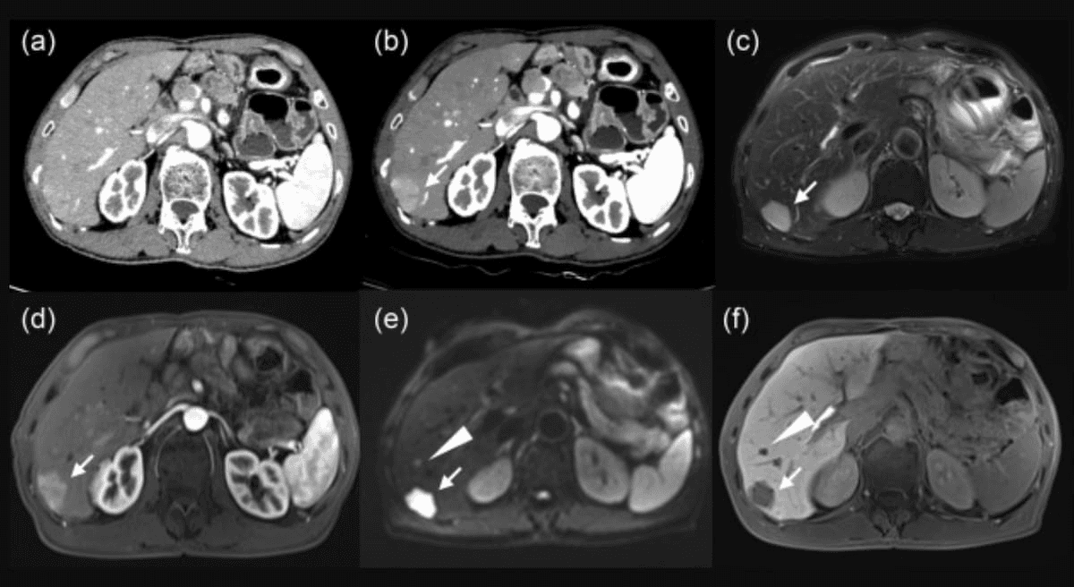 Comparative Study Says Enhanced MRI Offers Optimal Detection of Neuroendocrine Tumor Liver Metastases