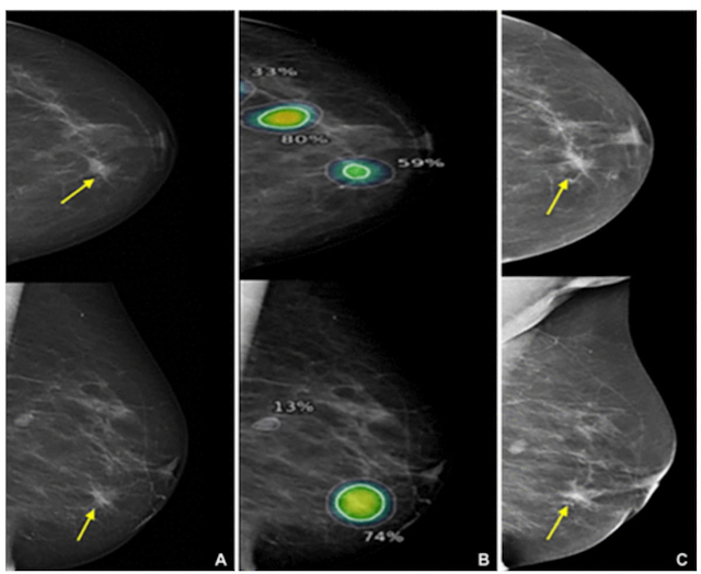 Mammography Study: Can Stand-Alone AI Enhance Detection of Interval Breast Cancer? 