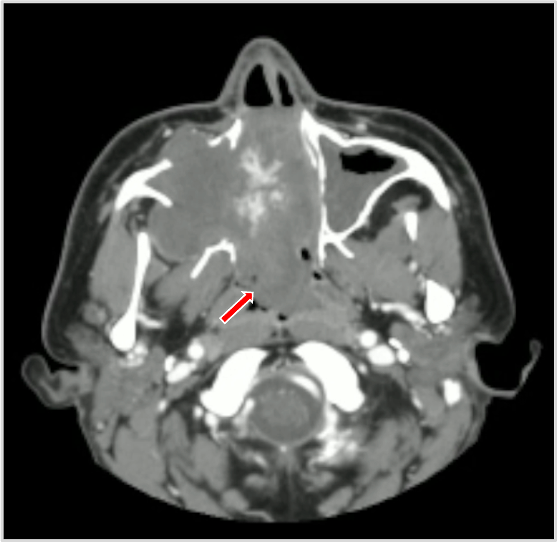 Image IQ Quiz: 19-Year-Old Male with Epistaxis and Obstruction