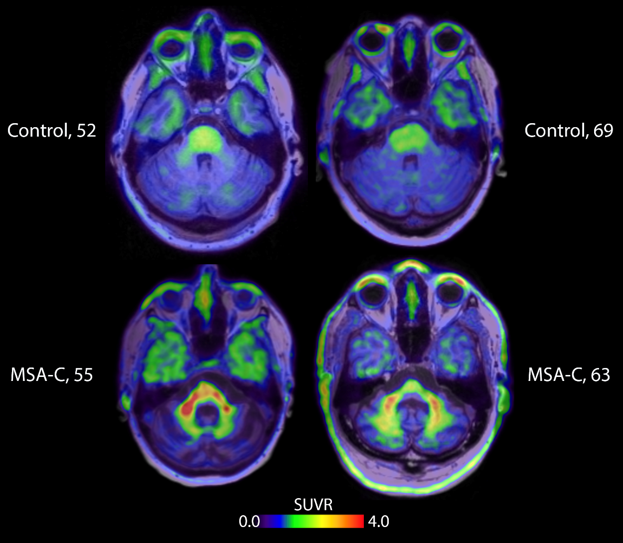 Researcher Presents First Non-Invasive Images of Alpha-Synuclein in the Brain