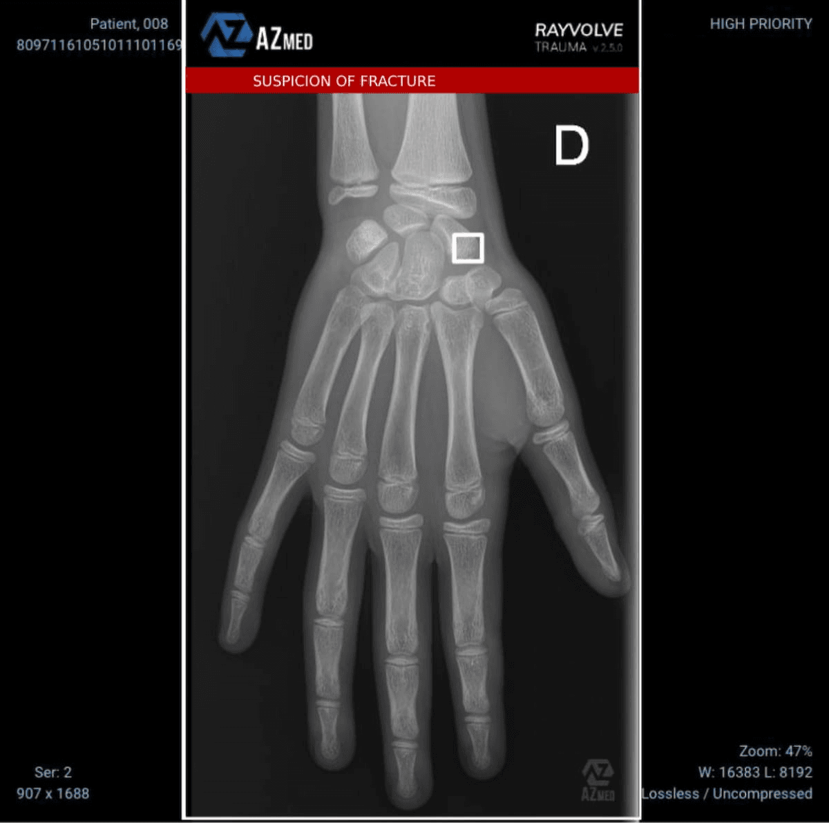 FDA Grants AI Platform Expanded Clearance for Pediatric Fracture Detection on X-Rays