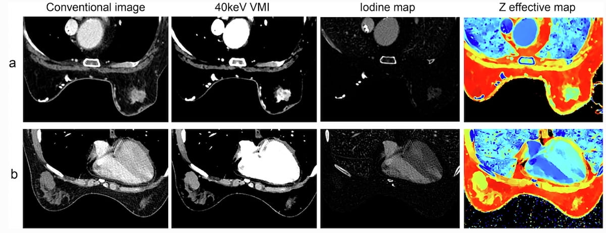 Can a Dual-Energy CT Model Bolster Breast Cancer Detection?