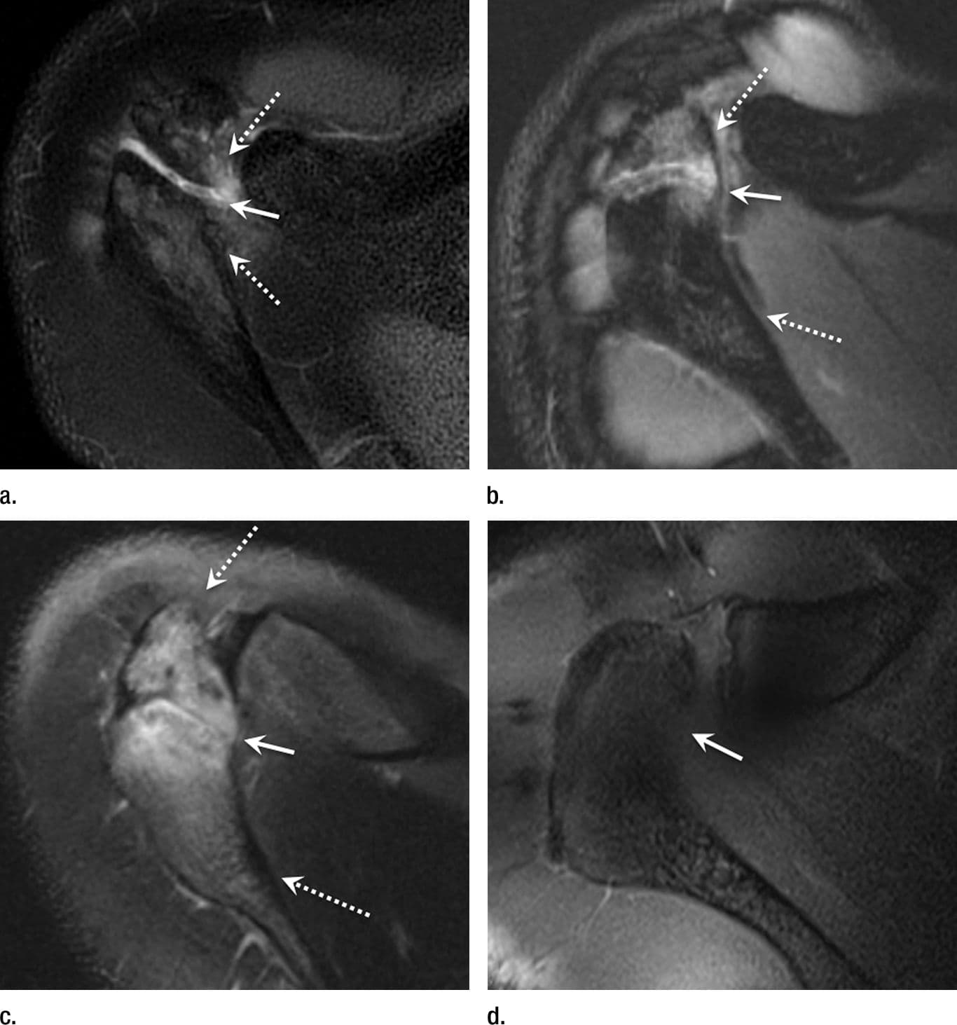 MRI Detects Shoulder Damage in Young Baseball Pitchers