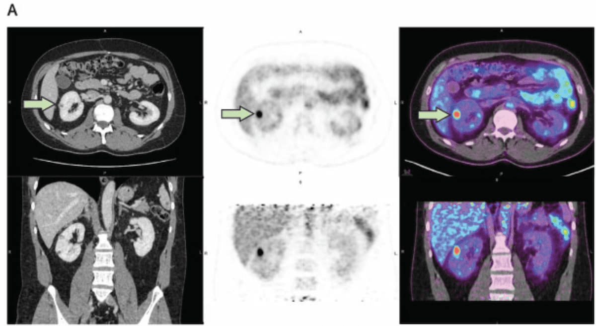 Study for Emerging PET/CT Agent Reveals ‘New Standard’ for Detecting Clear Cell Renal Cell Carcinoma