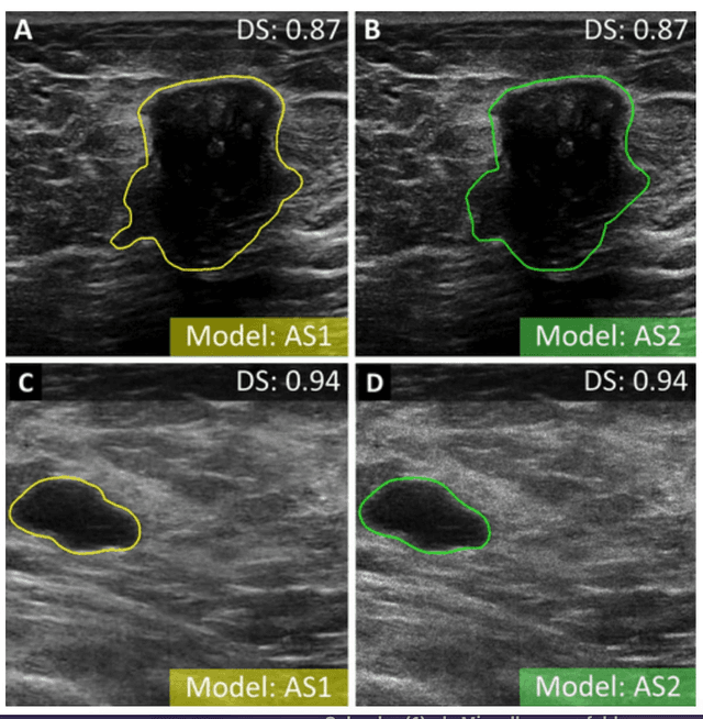 Can Radiomics and Autoencoders Enhance Real-Time Ultrasound Detection of Breast Cancer?