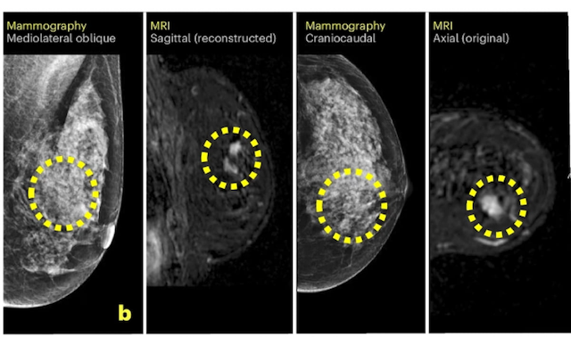 Can AI Facilitate Effective Triage for Supplemental Breast MRI After Negative Mammography Screening?