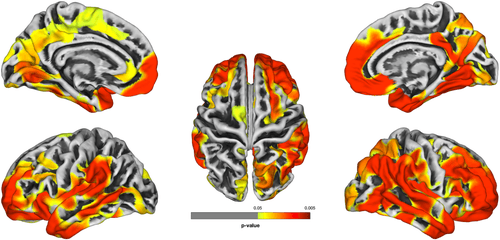 MRI Scans Reveal Further Evidence of Dementia Risk in World Trade Center First Responders