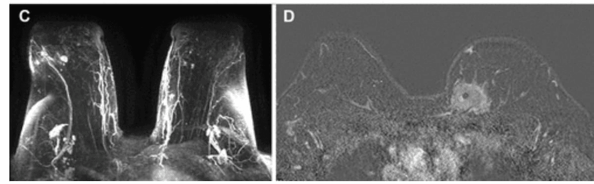 New Study Finds Racial Disparities with Pre-Op Breast MRI and Positive Surgical Margin Rates