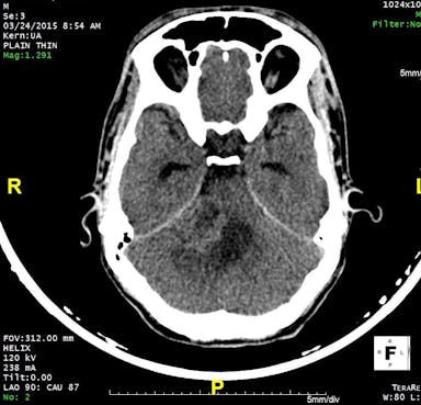 Image IQ: 28-year-old, Sensorineural Hearing Loss