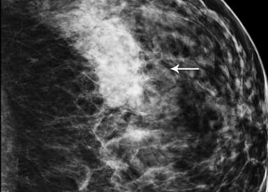 Image IQ: 42-year-old with Architectural Distortion on Breast Tomo