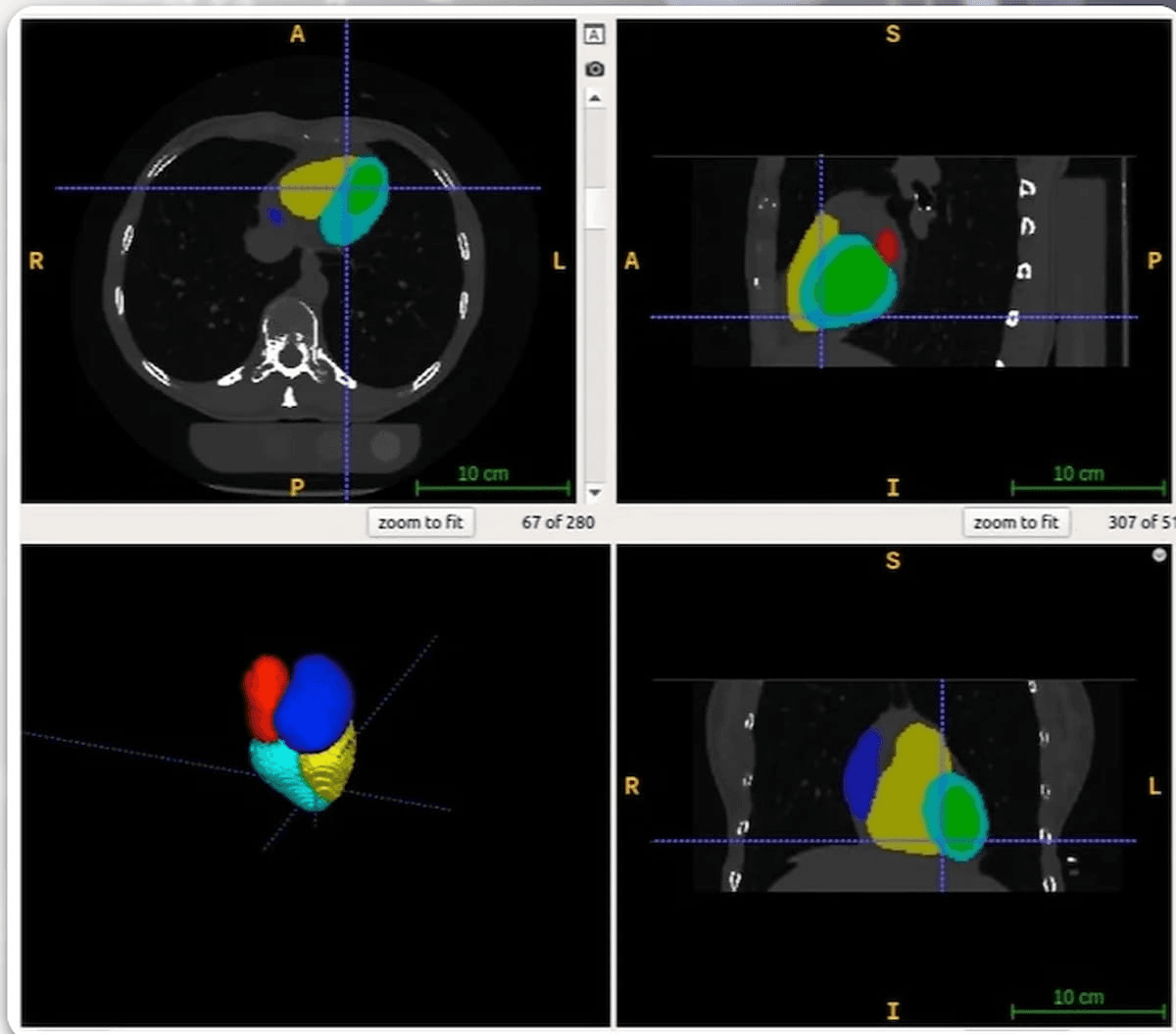 FDA Clears CT-Based AI Software for Detecting Enlarged Heart Chambers 