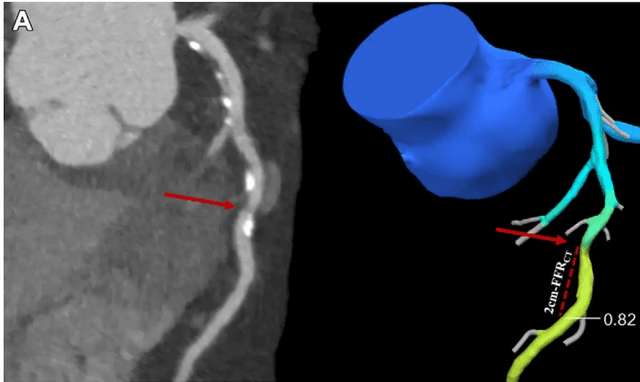 CT-Derived Fractional Flow Reserve Leads to Nearly 20 Percent Reduction of ICA in Cases of Suspected CAD