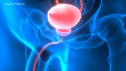 PSMA PET/CT Prompts Prostate Cancer Management Changes in 66 Percent of Patients With Recurrent Disease