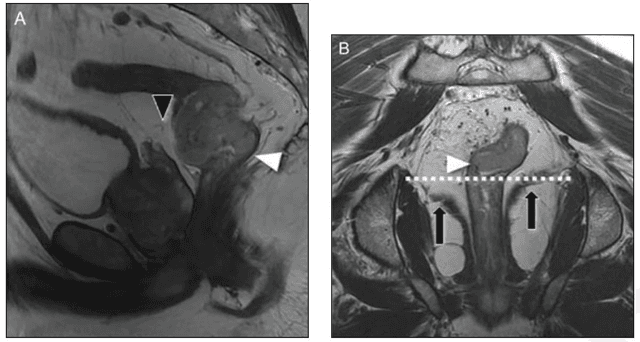 Rectal Cancer MRI: Seven Key Takeaways from a New Literature Review