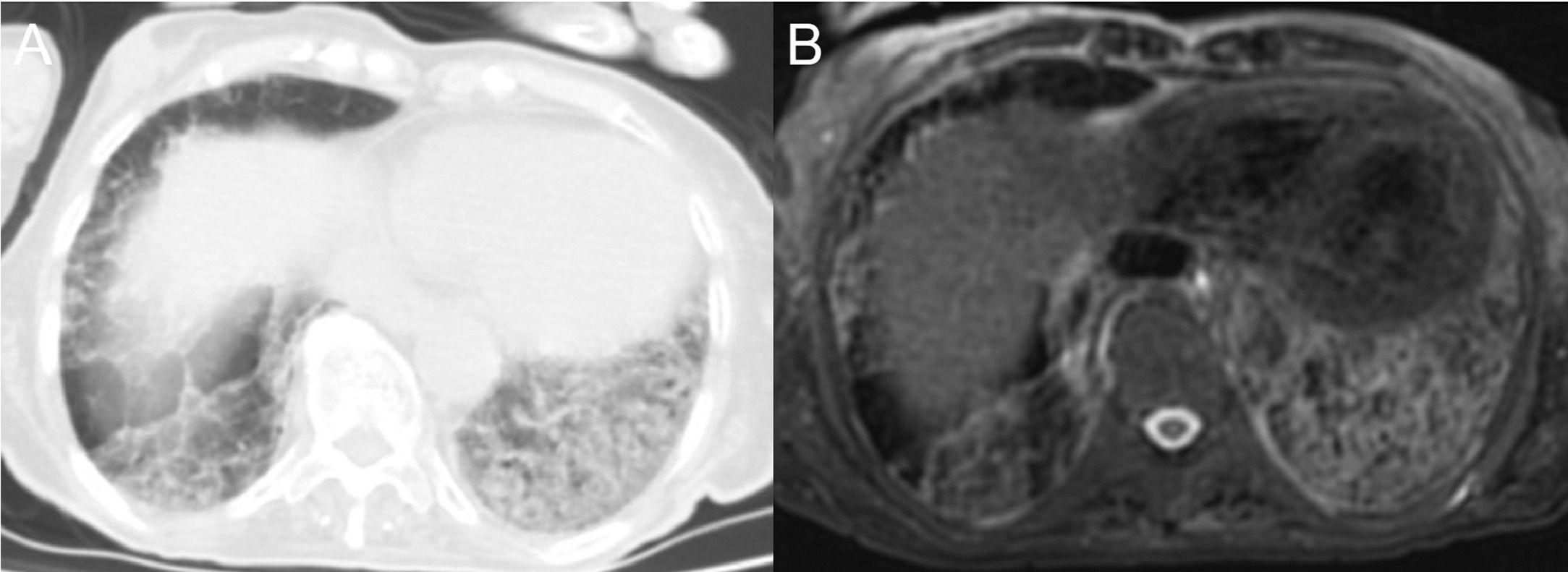 Thoracic MRI Is Effective as Alternative to CT in Detecting COVID-19 Pneumonia