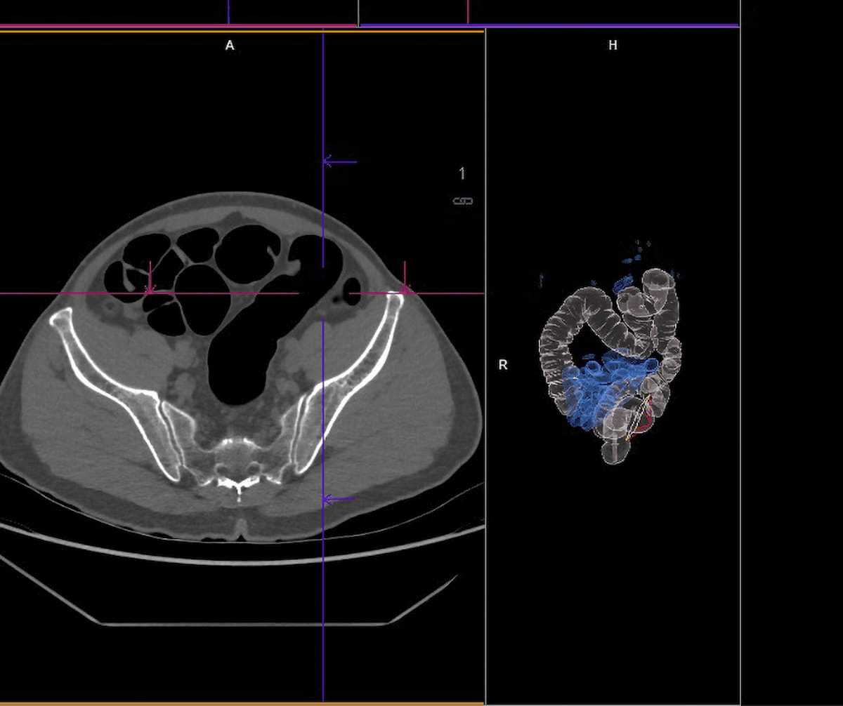 Survey Results Reveal Doubling of CT Colonography Use During COVID-19 Pandemic