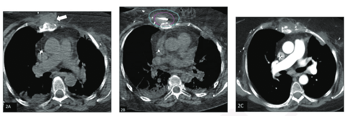 Interventional Radiology-Led Study Shows Benefits of CT-Guided Cryoablation for Soft Tissue Sarcoma