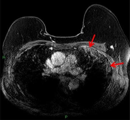 Breast MRI Spots Asymptomatic COVID-19 Infection