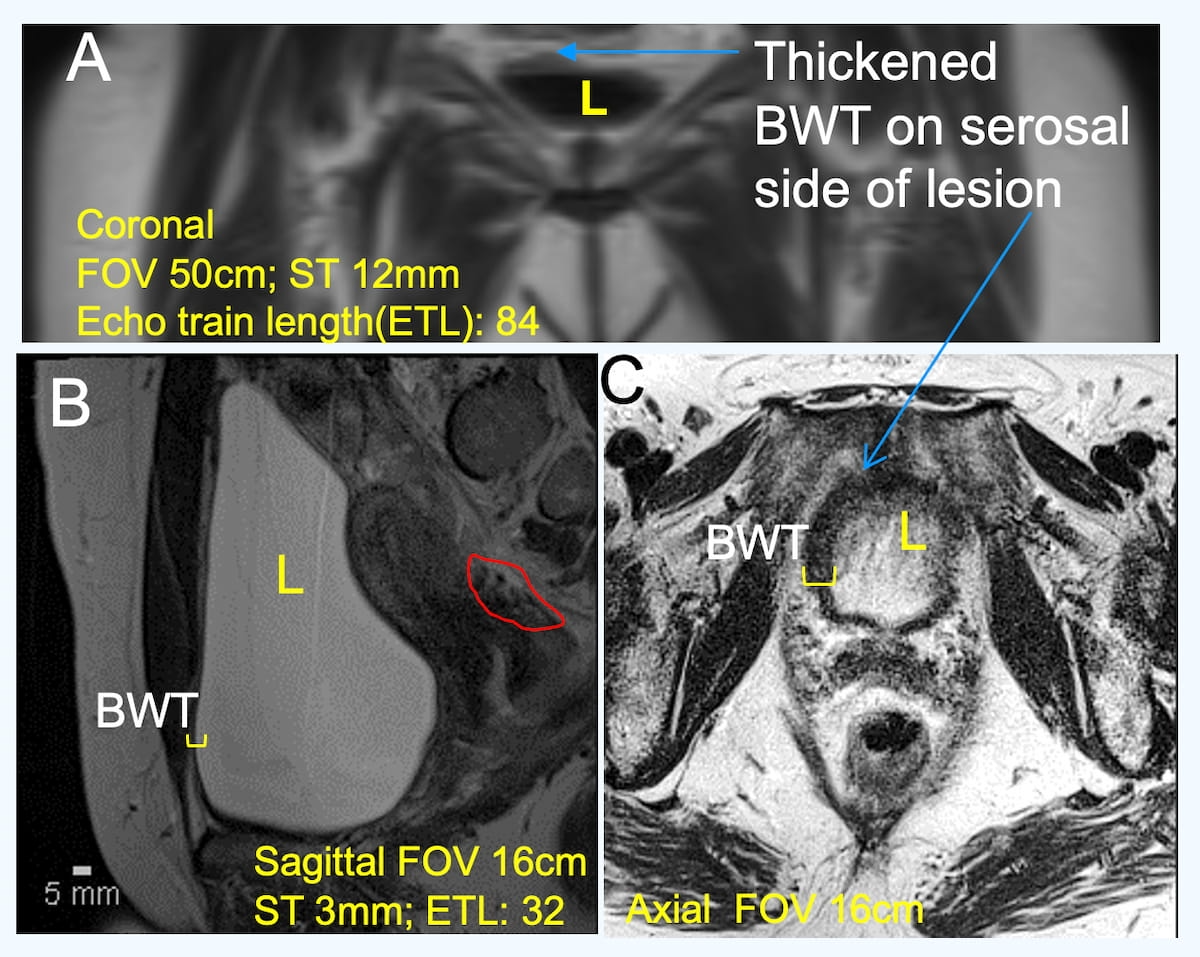 New Research Highlights Emerging MRI Contrast Agent for Bladder Imaging