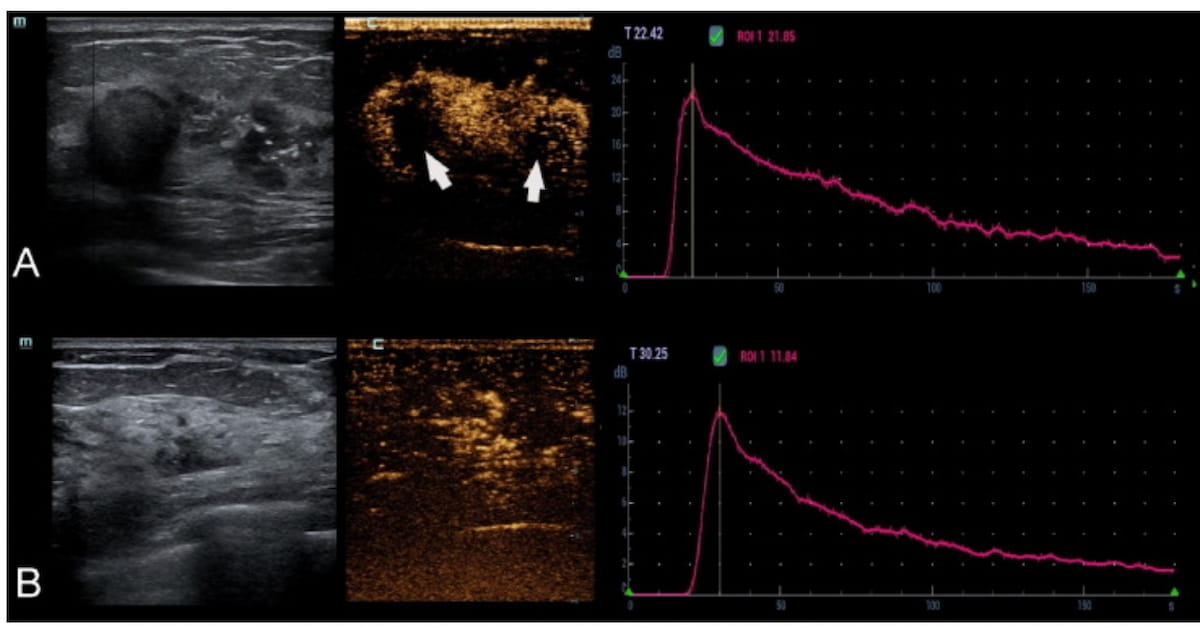 Predicting DCIS Upgrade to Invasive Breast Cancer: Can Contrast-Enhanced Ultrasound Have an Impact?