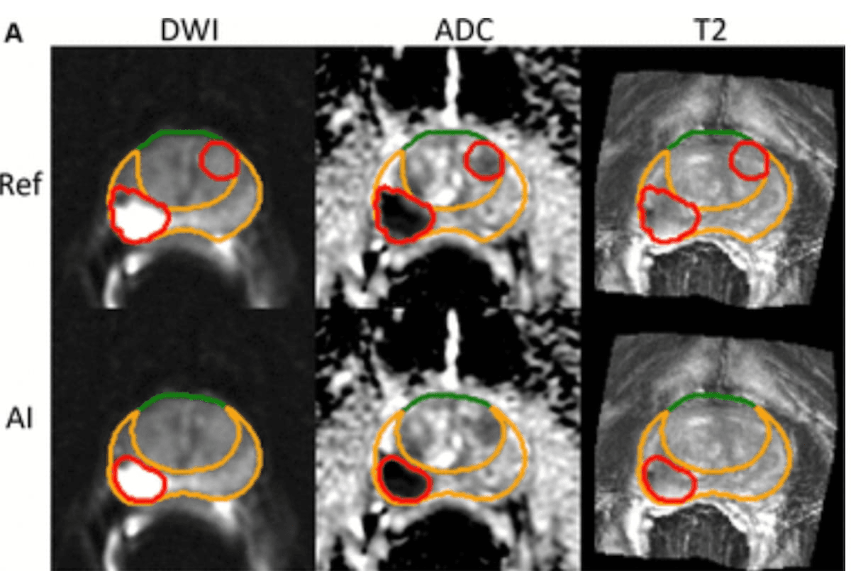 AI Segmentation, Intraprostatic Tumor Volume and Metastases: What a New mpMRI Study Reveals 