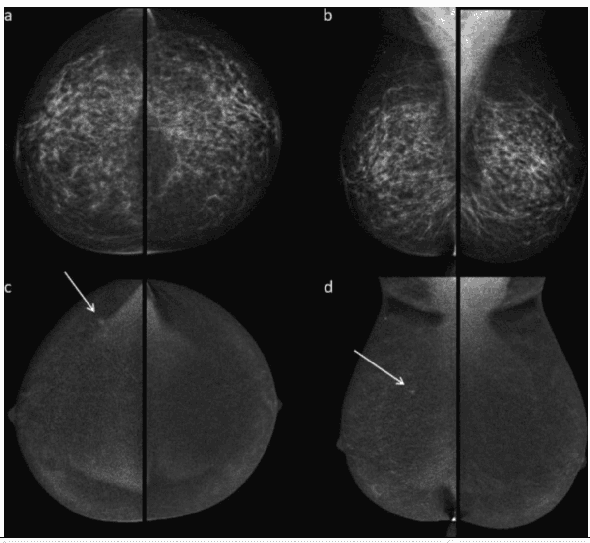 Long-Term Study Shows Merits of Contrast-Enhanced Mammography for Women with Higher Breast Cancer Risk