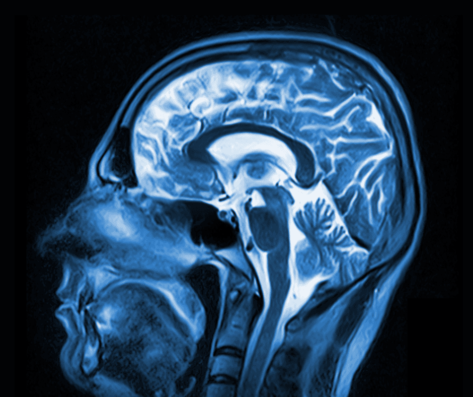 MRI Study Offers Insights on Traumatic Brain Injury and Cerebral Microbleeds