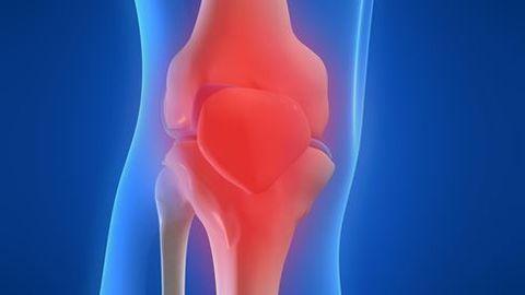 MRI Detects Osteoarthritis Years Before Symptoms with Artificial Intelligence