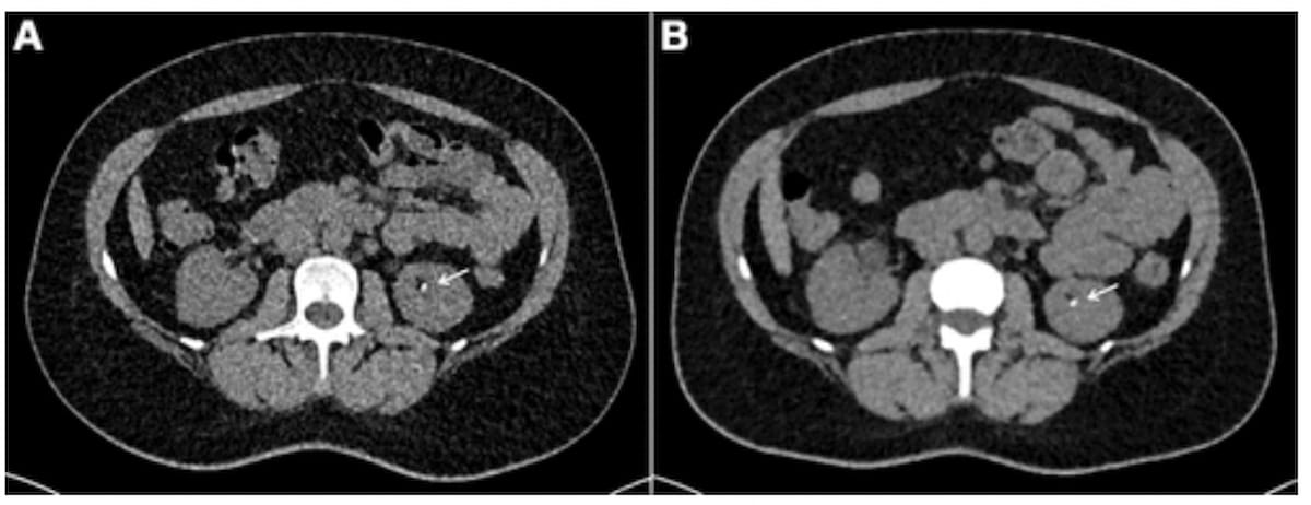 Study: Photon Counting CT Reduces Radiation Exposure by 44 Percent for Kidney Stone Detection 