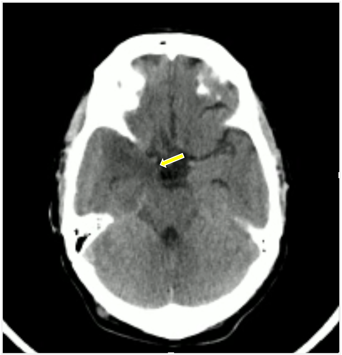 Image IQ Quiz: 49-Year-Old Woman with Mental Status Changes and Fever