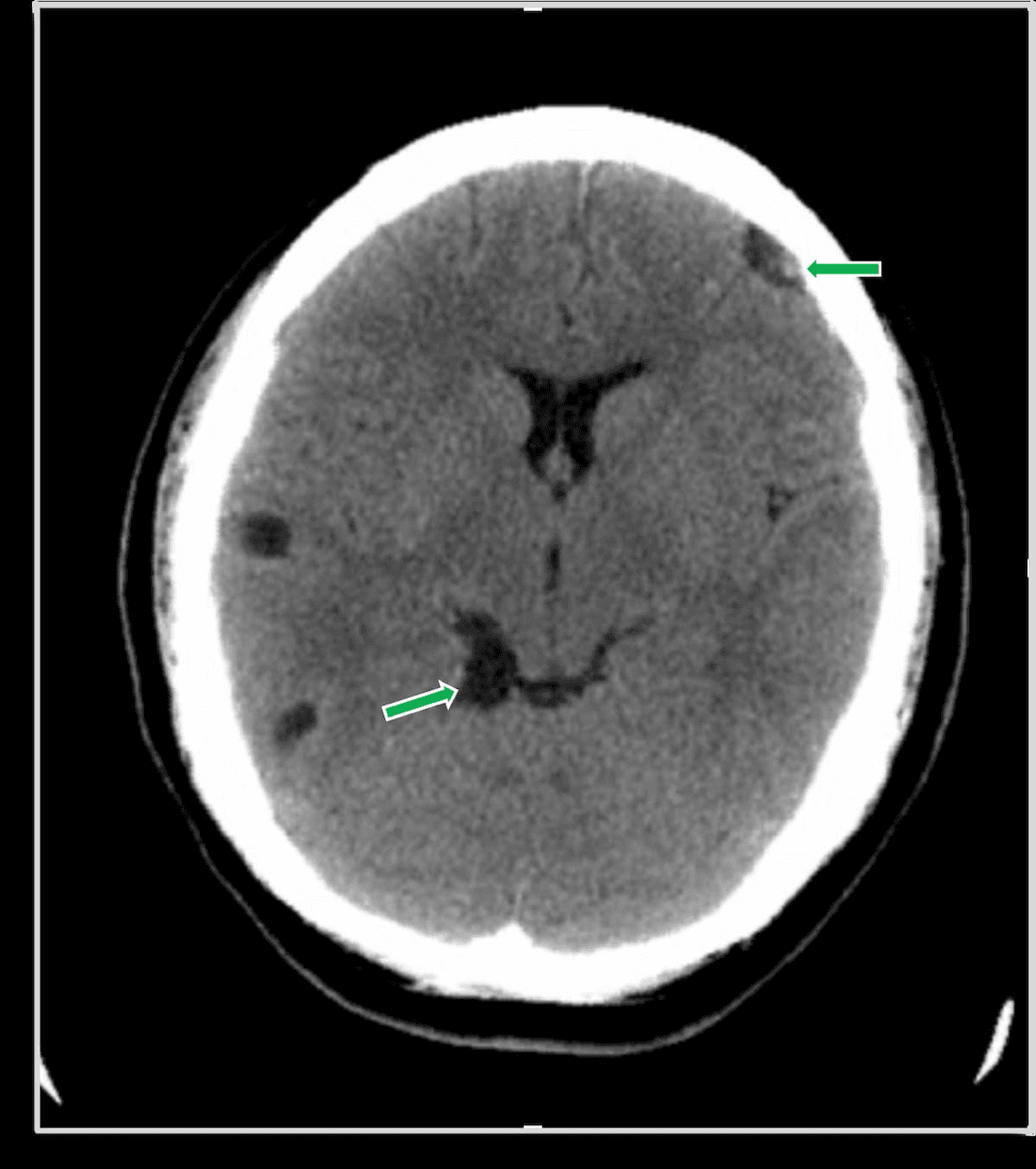 Image IQ Quiz: 30-Year-Old Woman with Fever and Headache