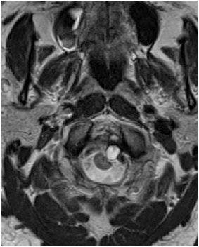 Image IQ: 69 year old man with headaches.