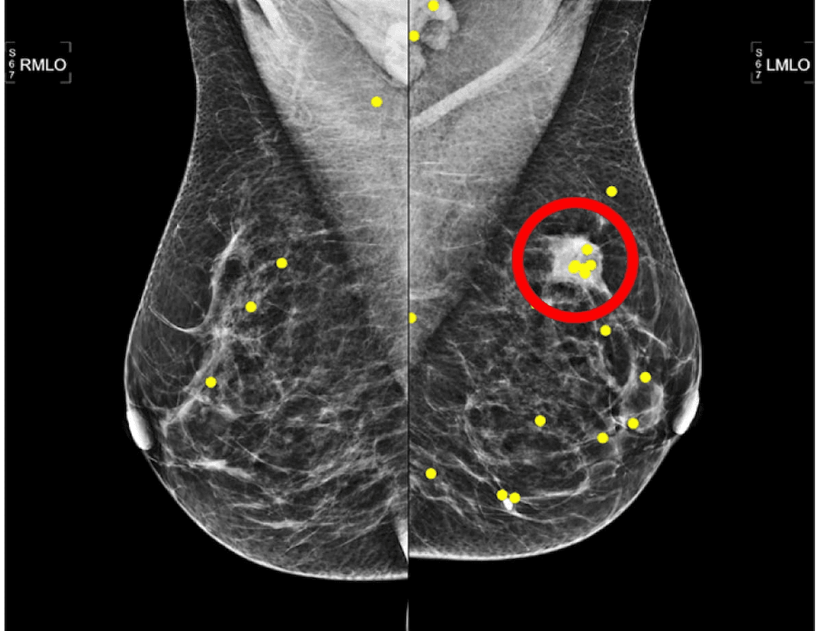 Could a Mammography Worklist in Order of Increasing Breast Density Bolster Interpretation and Efficiency?